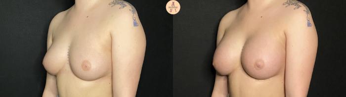 Before & After Breast Augmentation Case 190 Left Oblique View in San Antonio, Texas