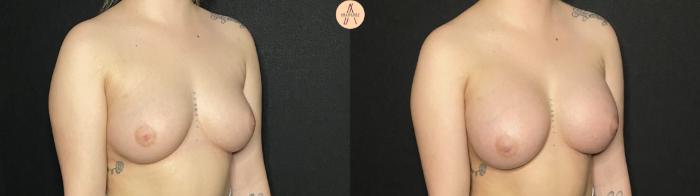 Before & After Breast Augmentation Case 190 Right Oblique View in San Antonio, Texas