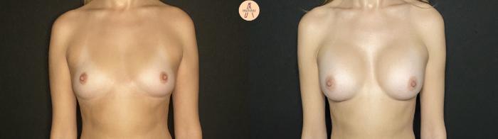 Before & After Breast Augmentation Case 191 Front View in San Antonio, Texas
