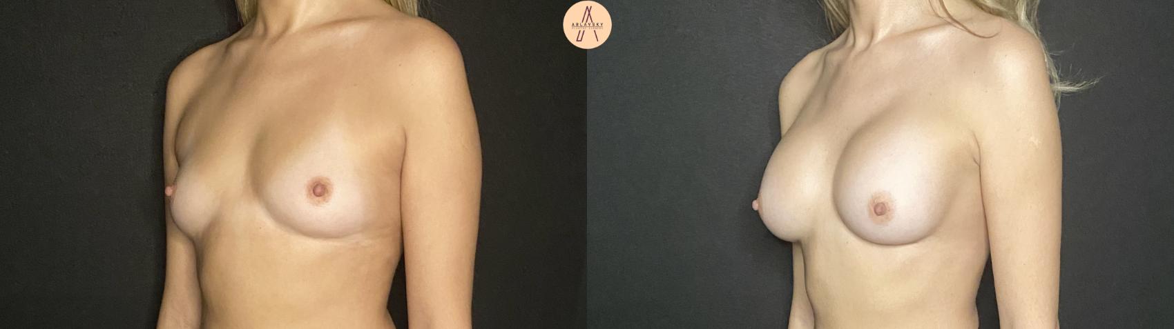 Before & After Breast Augmentation Case 191 Left Oblique View in San Antonio, Texas