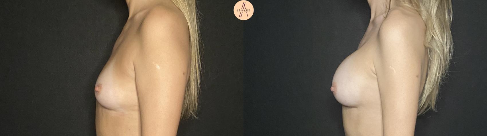 Before & After Breast Augmentation Case 191 Left Side View in San Antonio, Texas