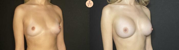 Before & After Breast Augmentation Case 191 Right Oblique View in San Antonio, Texas