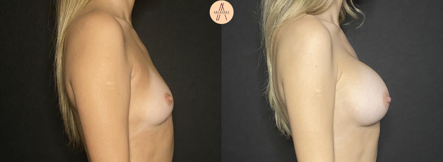 Before & After Breast Augmentation Case 191 Right Side View in San Antonio, Texas