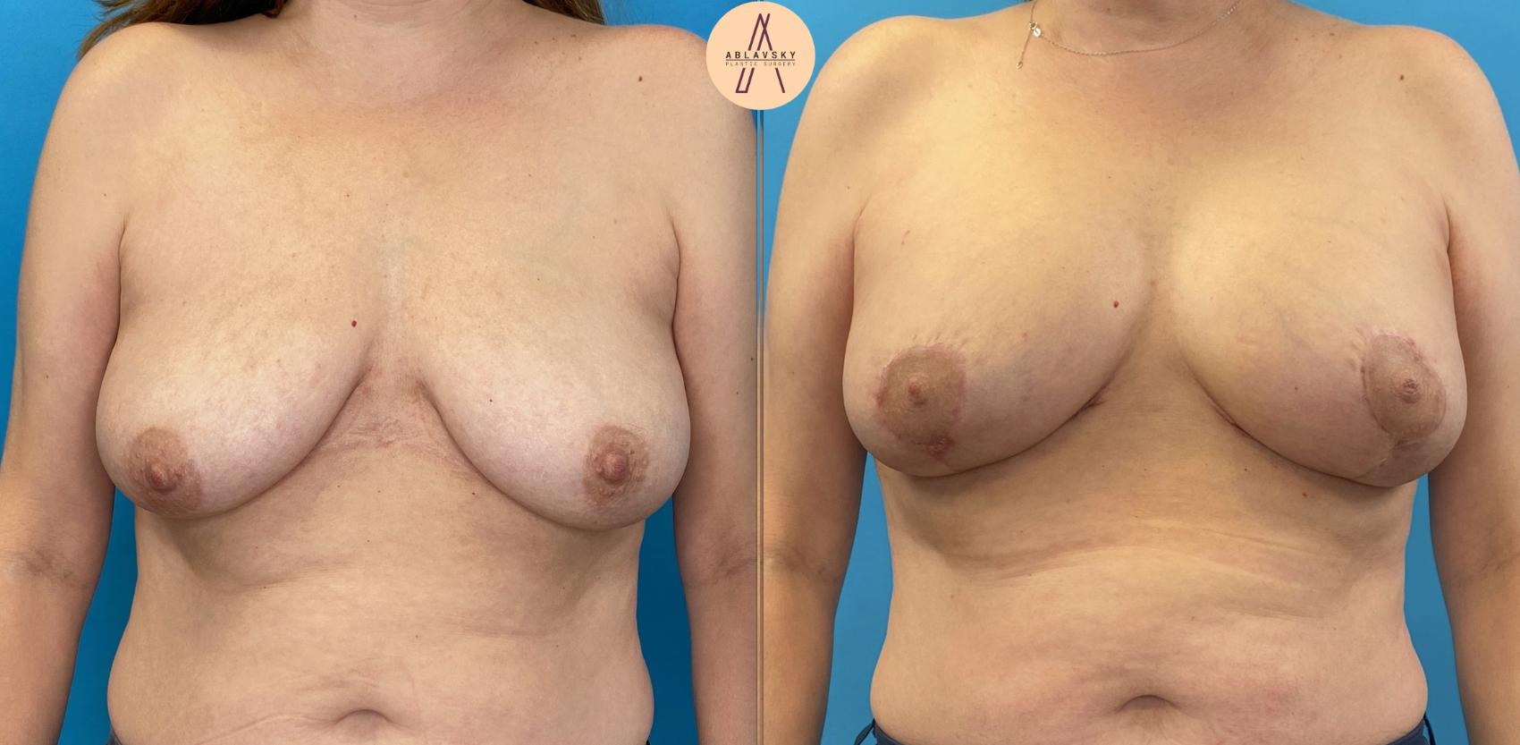 Before & After Breast Augmentation Case 2 Front View in San Antonio, Texas