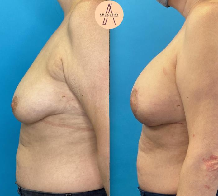 Before & After Breast Augmentation Case 2 Right Side View in San Antonio, Texas