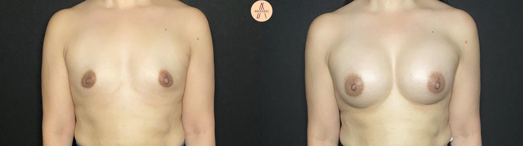 Before & After Breast Augmentation Case 207 Front View in San Antonio, Texas