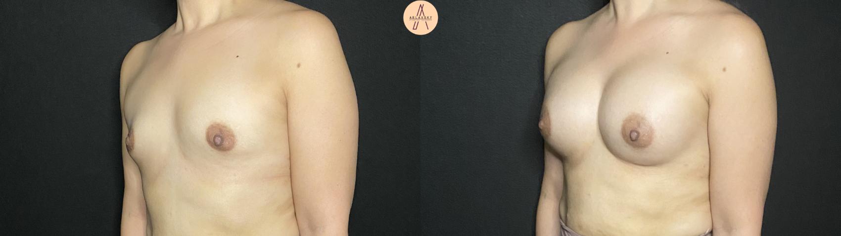 Before & After Breast Augmentation Case 207 Left Oblique View in San Antonio, Texas
