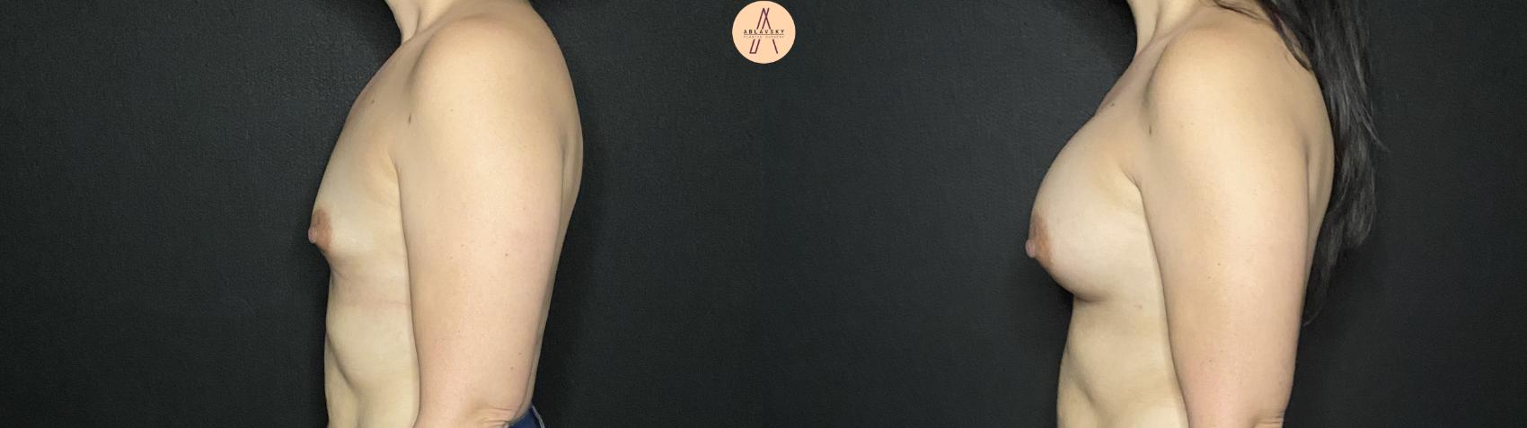 Before & After Breast Augmentation Case 207 Left Side View in San Antonio, Texas