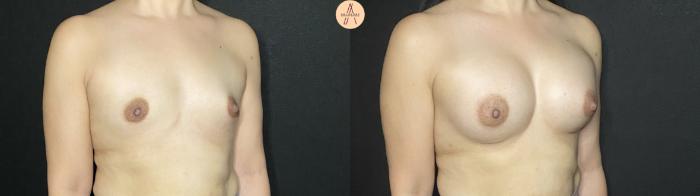 Before & After Breast Augmentation Case 207 Right Oblique View in San Antonio, Texas