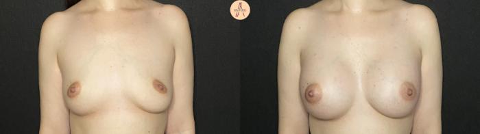 Before & After Breast Augmentation Case 208 Front View in San Antonio, Texas