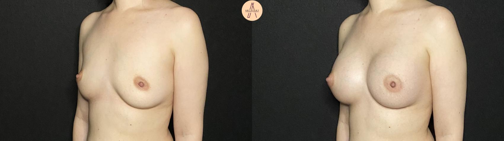Before & After Breast Augmentation Case 208 Left Oblique View in San Antonio, Texas