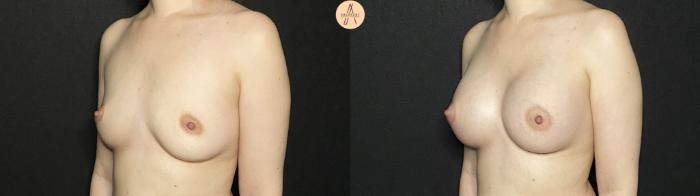 Before & After Breast Augmentation Case 208 Left Oblique View in San Antonio, Texas