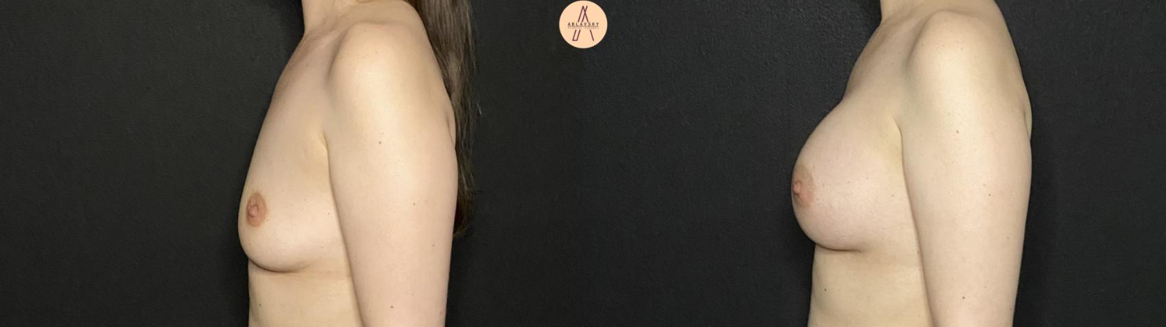 Before & After Breast Augmentation Case 208 Left Side View in San Antonio, Texas