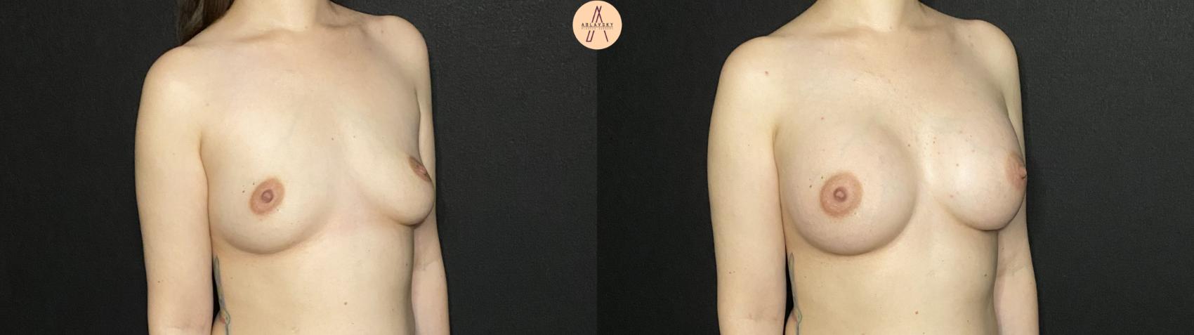 Before & After Breast Augmentation Case 208 Right Oblique View in San Antonio, Texas