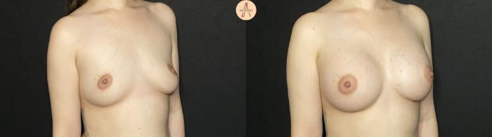 Before & After Breast Augmentation Case 208 Right Oblique View in San Antonio, Texas