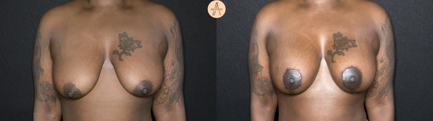 Before & After Breast Lift Case 239 Front View in San Antonio, Texas