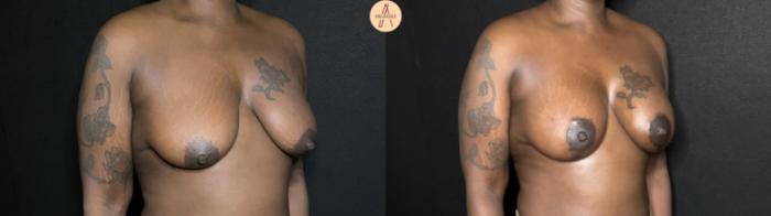 Before & After Breast Augmentation Case 239 Right Oblique View in San Antonio, Texas