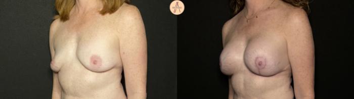 Before & After Breast Augmentation Case 247 Left Oblique View in San Antonio, Texas