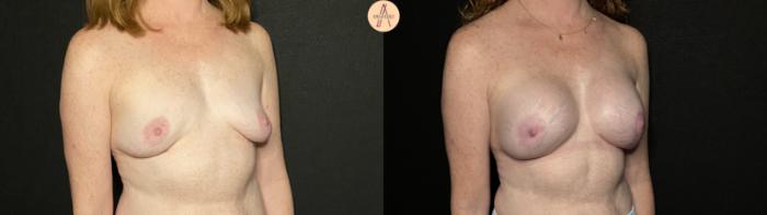 Before & After Breast Augmentation Case 247 Right Oblique View in San Antonio, Texas