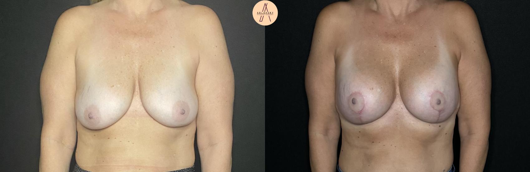 Before & After Breast Augmentation Case 252 Front View in San Antonio, Texas