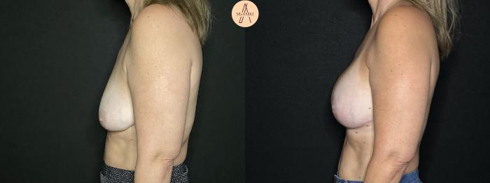 Before & After Breast Lift Case 252 Left Side View in San Antonio, Texas