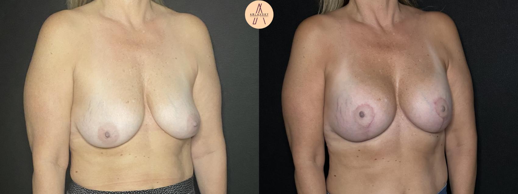 Before & After Breast Lift Case 252 Right Oblique View in San Antonio, Texas