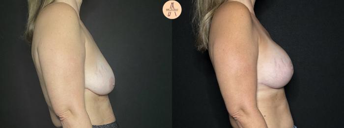 Before & After Breast Lift Case 252 Right Side View in San Antonio, Texas