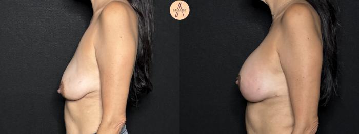 Before & After Breast Lift Case 261 Left Side View in San Antonio, Texas