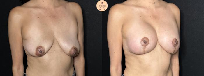 Before & After Breast Augmentation Case 261 Right Oblique View in San Antonio, Texas