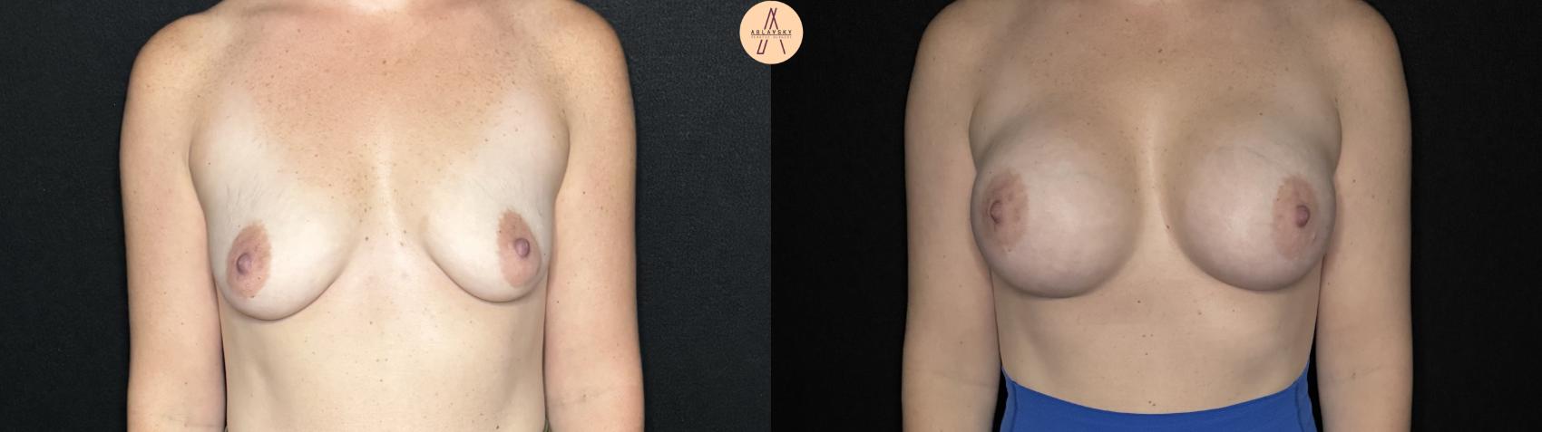 Before & After Breast Augmentation Case 264 Front View in San Antonio, Texas