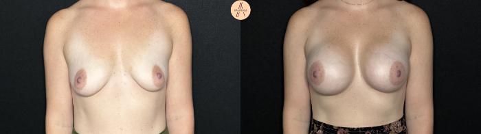 Before & After Breast Augmentation Case 264 Front View in San Antonio, Texas