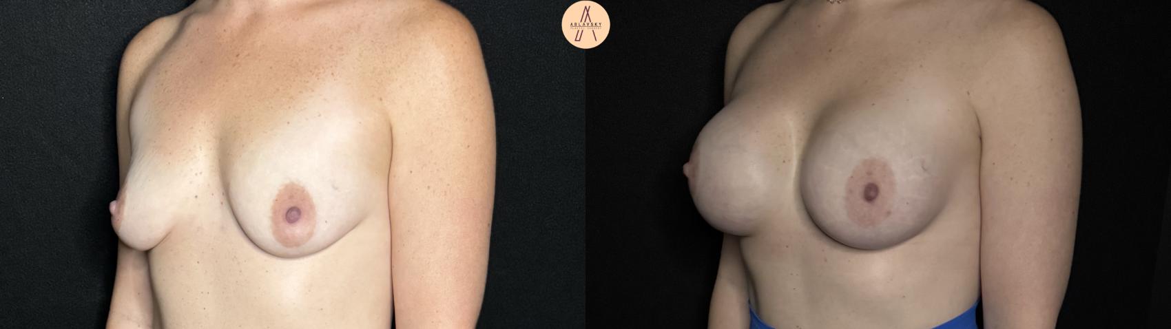 Before & After Breast Augmentation Case 264 Left Oblique View in San Antonio, Texas
