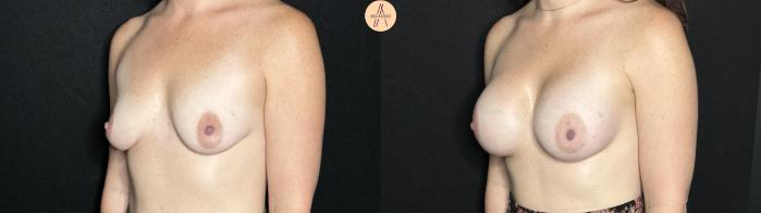 Before & After Breast Augmentation Case 264 Left Oblique View in San Antonio, Texas