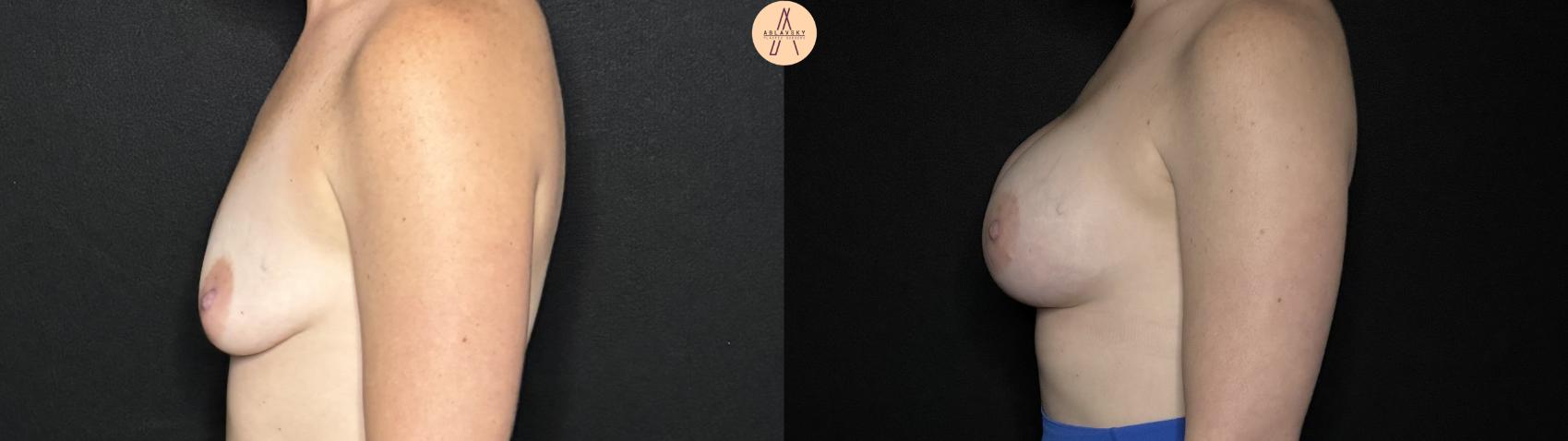 Before & After Breast Augmentation Case 264 Left Side View in San Antonio, Texas