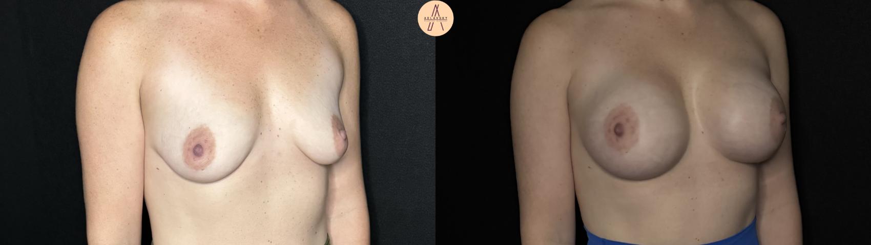 Before & After Breast Augmentation Case 264 Right Oblique View in San Antonio, Texas