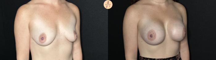 Before & After Breast Augmentation Case 264 Right Oblique View in San Antonio, Texas