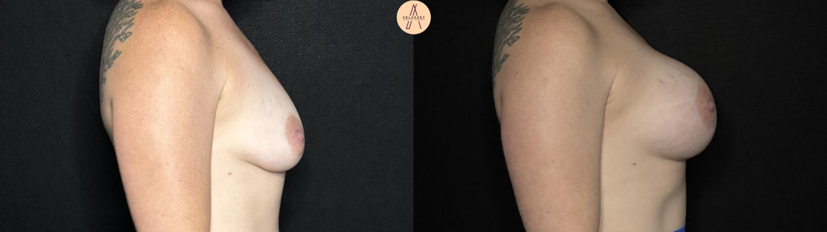Before & After Breast Augmentation Case 264 Right Side View in San Antonio, Texas