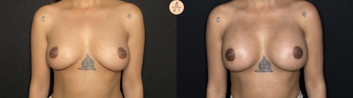 Before & After Breast Augmentation Case 269 Front View in San Antonio, Texas