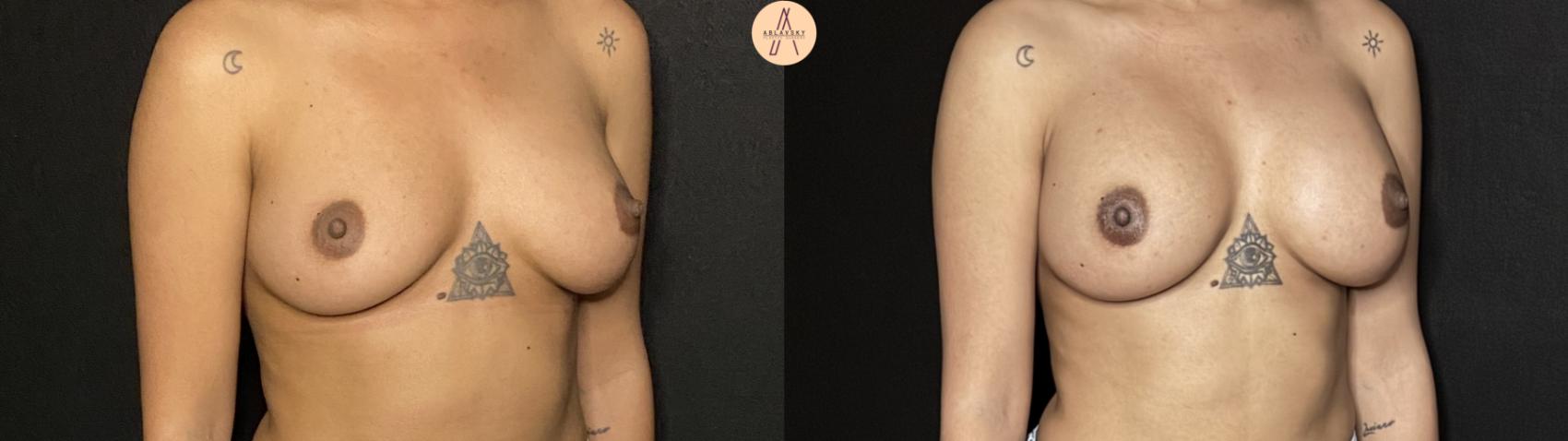 Before & After Breast Augmentation Case 269 Left Oblique View in San Antonio, Texas