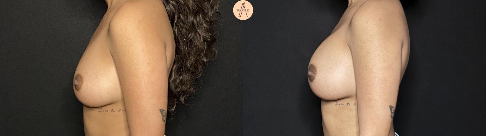 Before & After Breast Augmentation Case 269 Right Side View in San Antonio, Texas