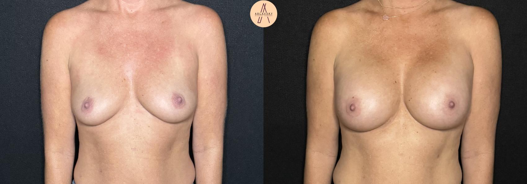 Before & After Breast Augmentation Case 286 Front View in San Antonio, Texas