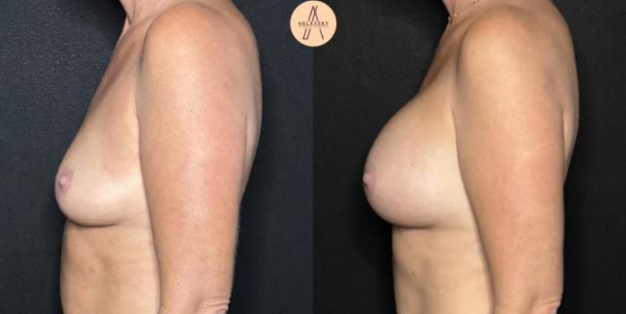 Before & After Breast Augmentation Case 286 Left Side View in San Antonio, Texas