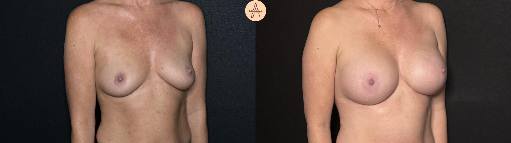 Before & After Breast Augmentation Case 286 Right Oblique View in San Antonio, Texas