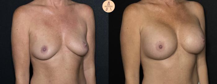 Before & After Breast Augmentation Case 286 Right Oblique View in San Antonio, Texas