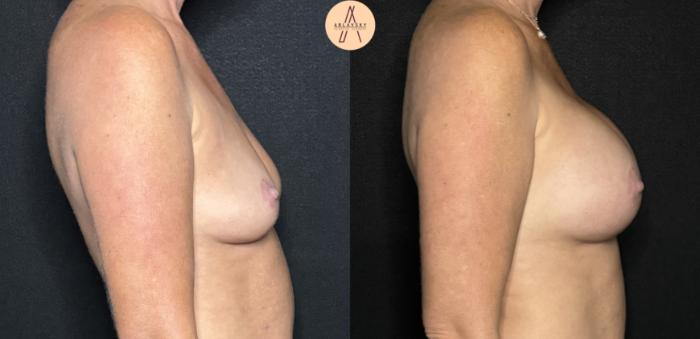 Before & After Breast Augmentation Case 286 Right Side View in San Antonio, Texas