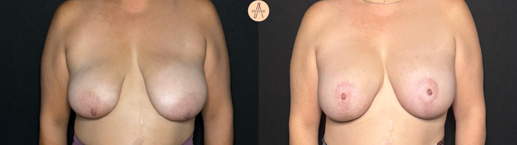 Before & After Breast Lift Case 289 Front View in San Antonio, Texas