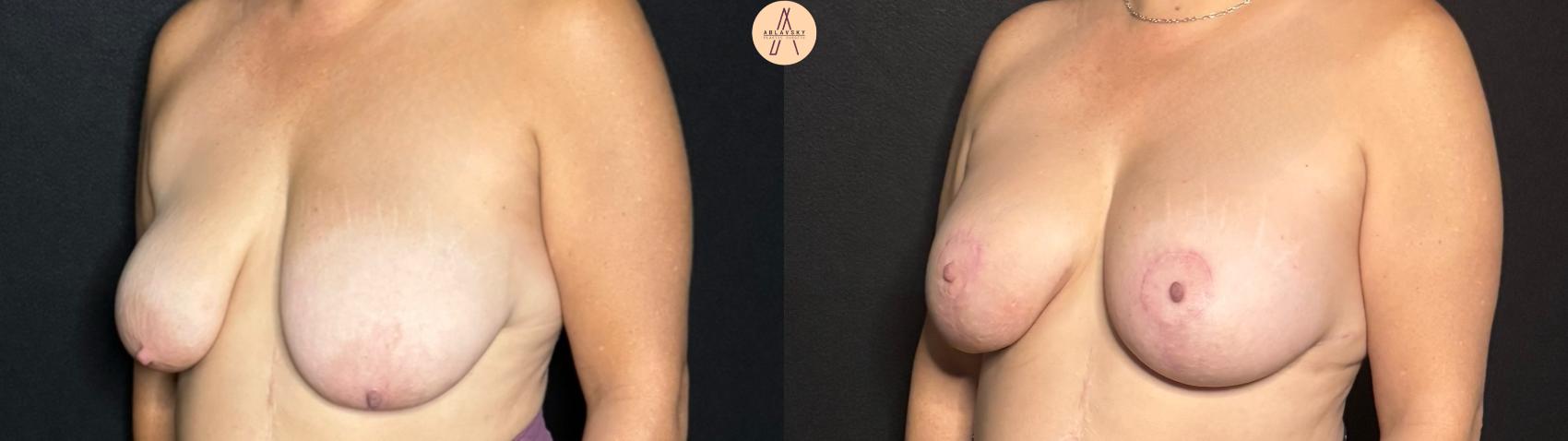 Before & After Breast Lift Case 289 Left Oblique View in San Antonio, Texas