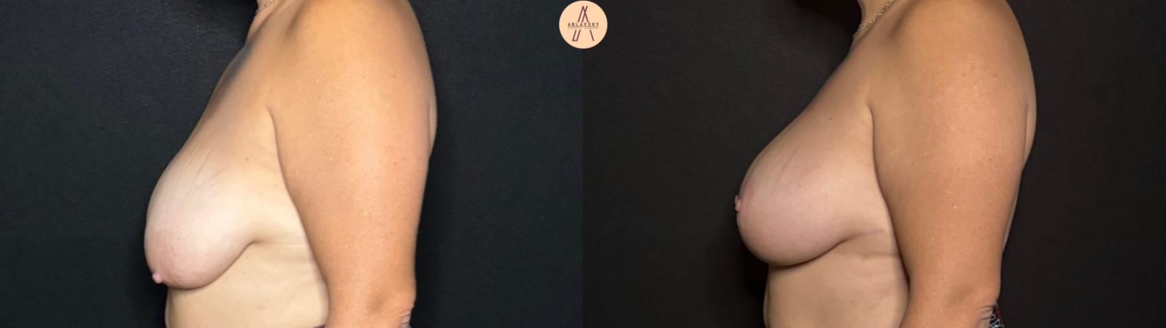 Before & After Breast Lift Case 289 Left Side View in San Antonio, Texas