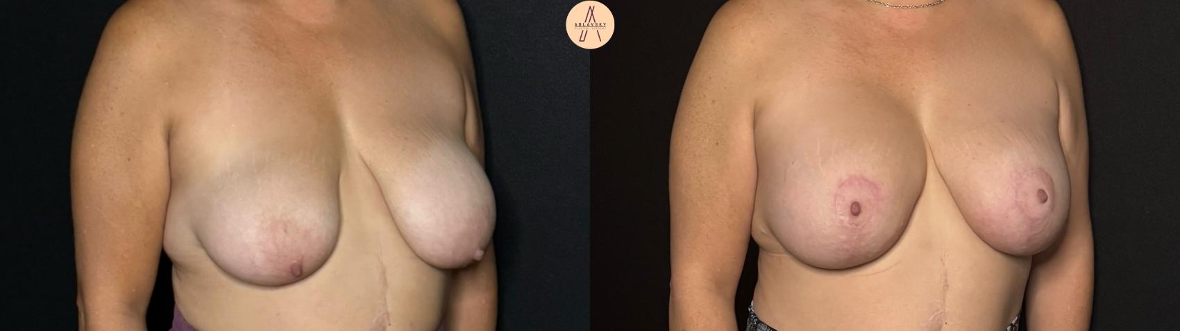 Before & After Breast Lift Case 289 Right Oblique View in San Antonio, Texas