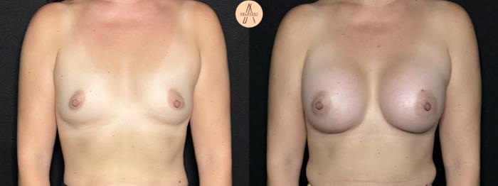 Before & After Breast Augmentation Case 293 Front View in San Antonio, Texas